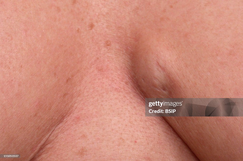 Sebaceous Cyst