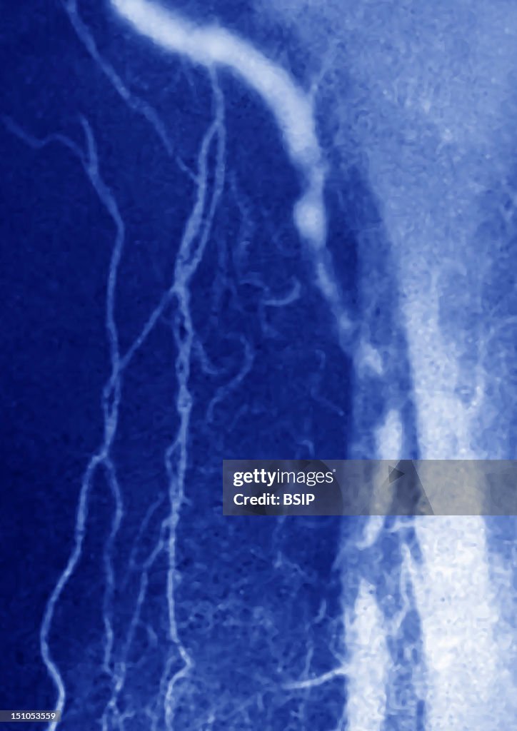 Popliteal Artery Stenosis, Angio