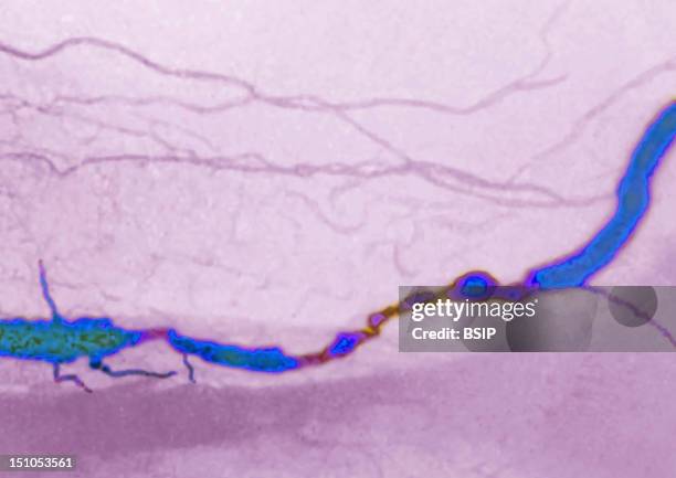 Arteritis Of The Popliteal Artery Due To A Lipidic And Calcareous Arteriosclerosis. Angiography Of The Knee. Side View.