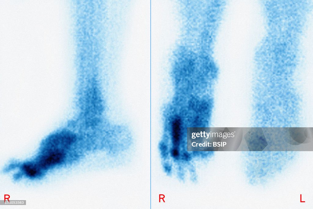 Perforating Ulcer In Diabetes