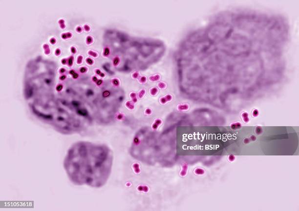 Gonococci Or Neisseria Gonorrhoeae In An Uretral Pus. This Bacterium Is Reponsible For Gonorrhea Blennorrhagia Or Clap, Urethritis, Vaginitis...