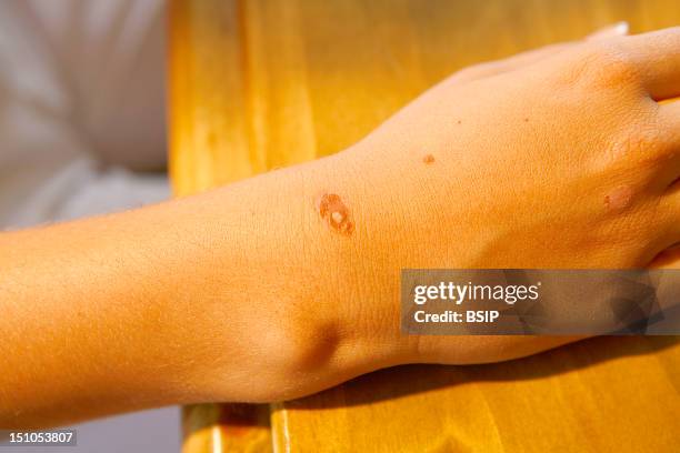 2,134 Wart Or Ingrown Hair Photos and Premium High Res Pictures - Getty Images 2,134 Wart Or Ingrown Hair Photos and Premium High Res Pictures - Getty Images