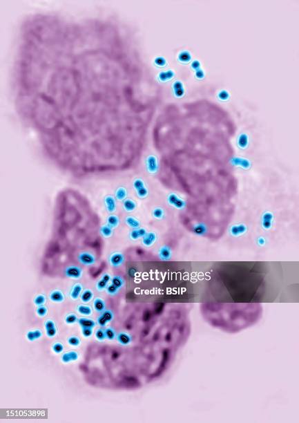 Gonococci Or Neisseria Gonorrhoeae In An Uretral Pus. This Bacterium Is Reponsible For Gonorrhea Blennorrhagia Or Clap, Urethritis, Vaginitis...