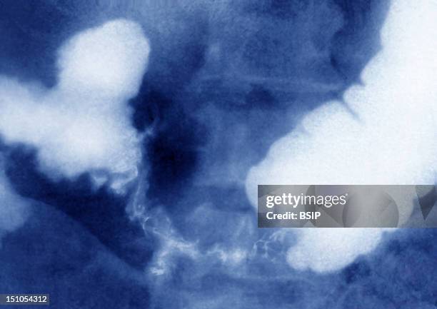 Transverse Colon Carcinoma. Abdominal X Ray In Front View.