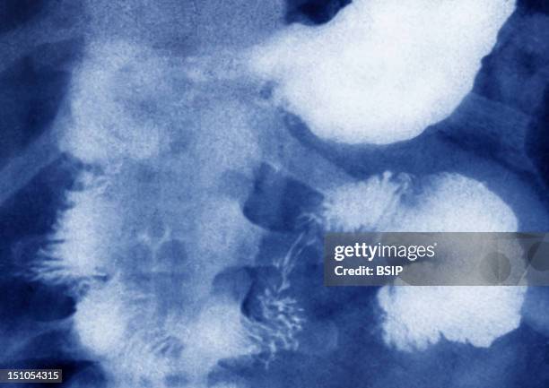 Compression And Constriction Of The Duodenum By A Carcinoma Of The Pancreatic Head. Abdominal X Ray In Front View.