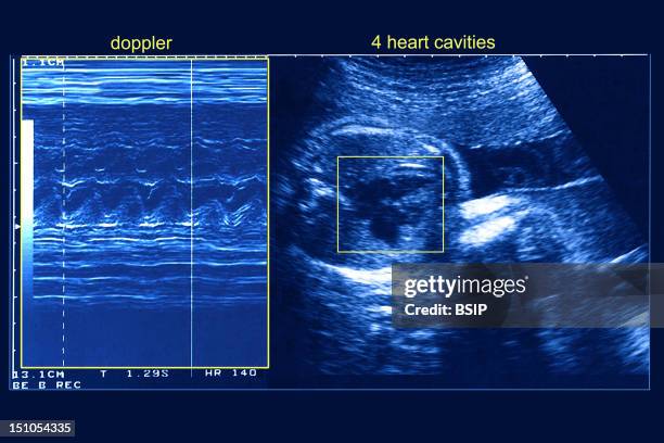 Doppler Ultrasound. Examination Of Cardiac Cavity Of A 5 Month Old Fetus. Axial View.