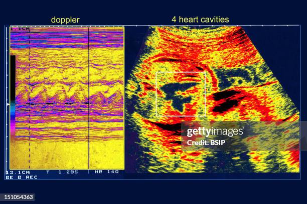 Doppler Ultrasound. Examination Of Cardiac Cavity Of A 5 Month Old Fetus. Axial View.
