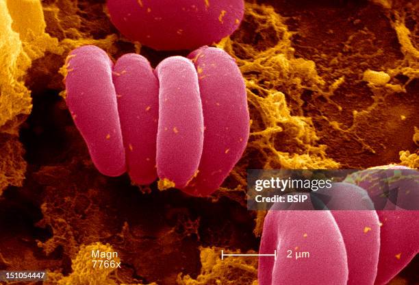 This Scanning Electron Micrograph Sem Depicted A Closer View Of A Number Of Red Blood Cells Found Enmeshed In A Fibrinous Matrix On The Luminal...