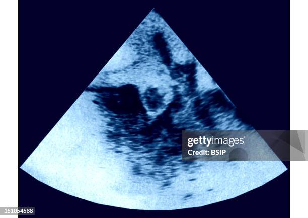 Cardiac Thrombus In The Left Atrium Is Causing An Atrial Fibrillation Cardiac Ultrasound.