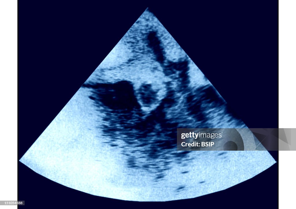 Intracardiac Thrombus, Sonog.