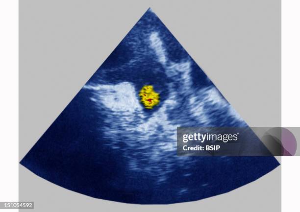 Cardiac Thrombus In The Left Atrium Is Causing An Atrial Fibrillation Cardiac Ultrasound.