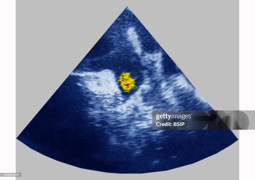 Intracardiac Thrombus, Sonog.