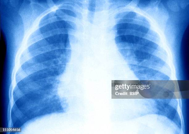 Respiratory Complications Of Measles. Frontal Chest X Ray.