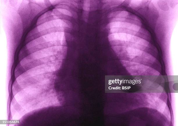 Respiratory Complications Of Measles. Frontal Chest X Ray.