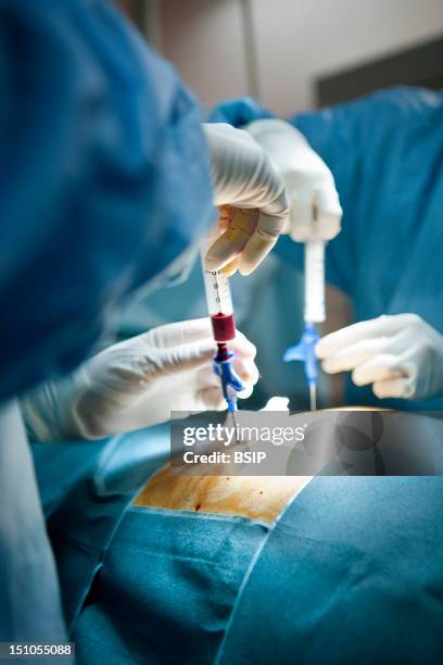 Photo Essay At Nice University Hospital, Archet Hospital About Bone Marrow Donation, France. Sampling Of Bone Marrow That Will Be Done In The...