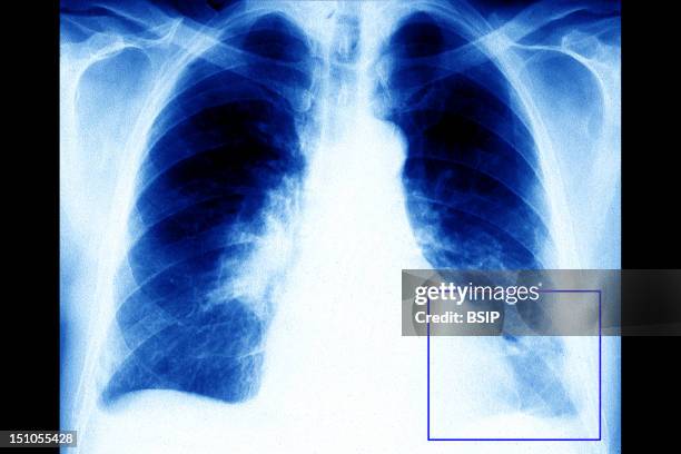 Blood Clot At Lung Level, At The Left Lower Lobe. X Ray, Frontal View.