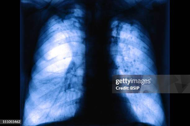 Pulmonary Emphysema Is Characterized By Pulmonary Alveola That Are Unable To Completely Deflate Hyperinflation, The Rupture Of Interalveolar Septa,...