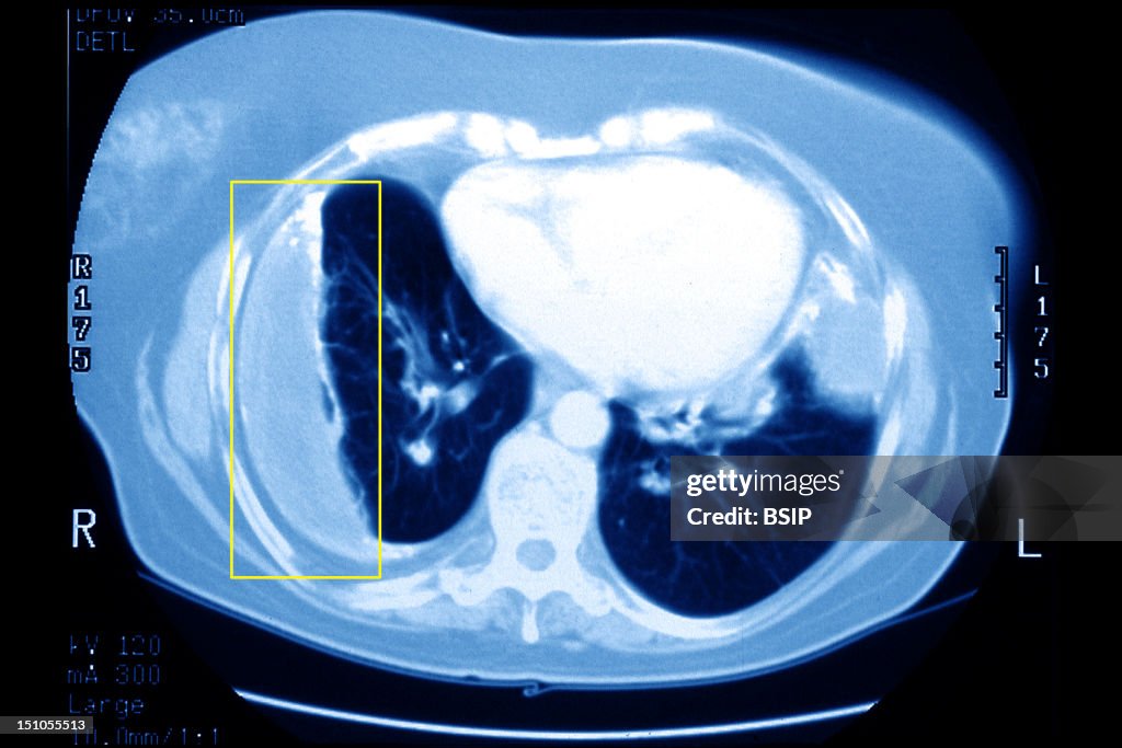 Pleurisy Scanner