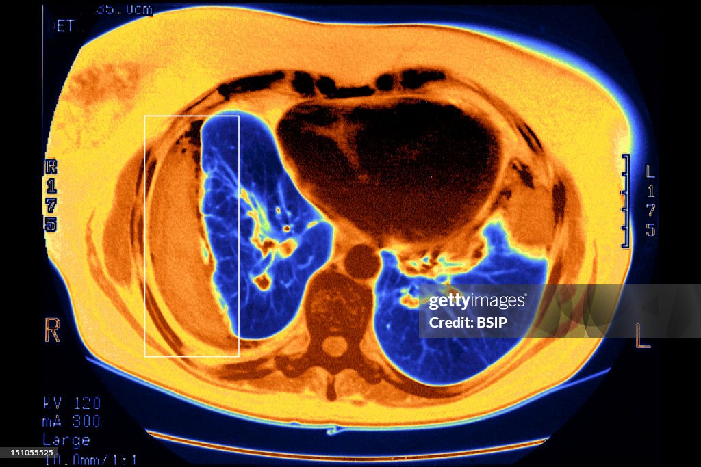 Pleurisy Scanner