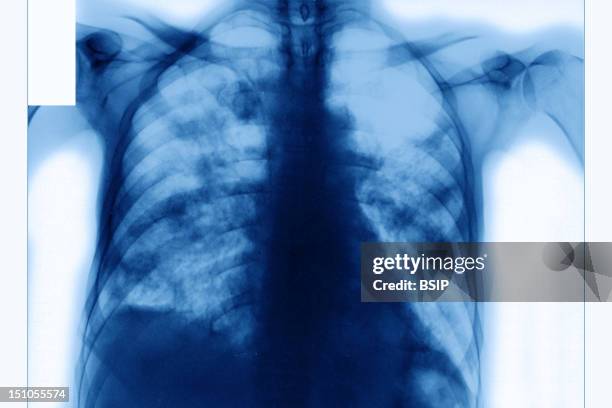 Pneumocystosis In Aids Infected Patient. X Ray, Frontal View.