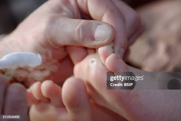 Patient And Doctor. Treatment Of A Plantar Wart On The Foot Of A 8 Year Old Girl By Cryotherapy Liquid Nitrogen At 180° C At A Dermatologist. After...