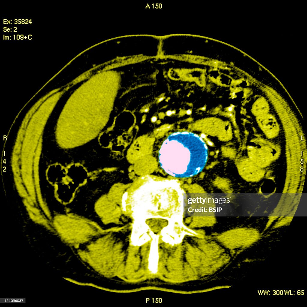 Abdominal Aorta Aneurysm, Scan