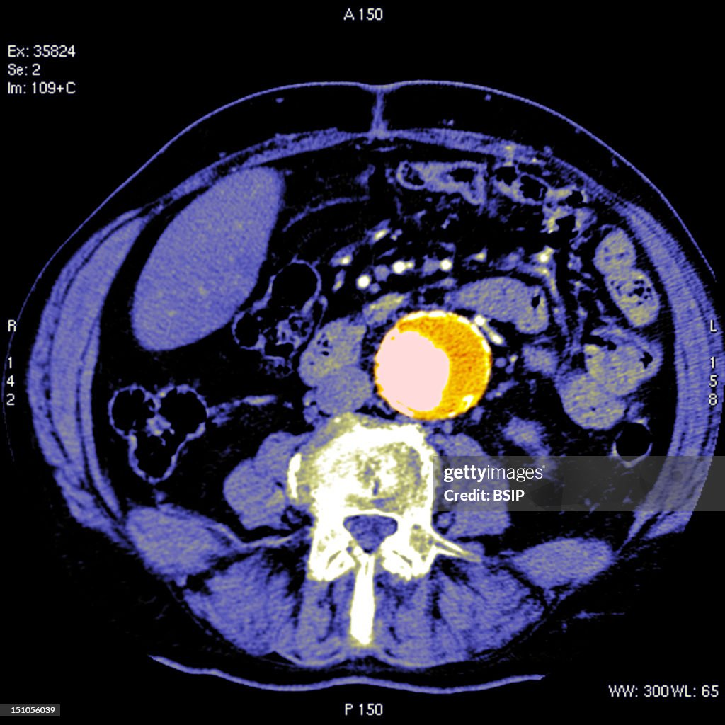 Abdominal Aorta Aneurysm, Scan