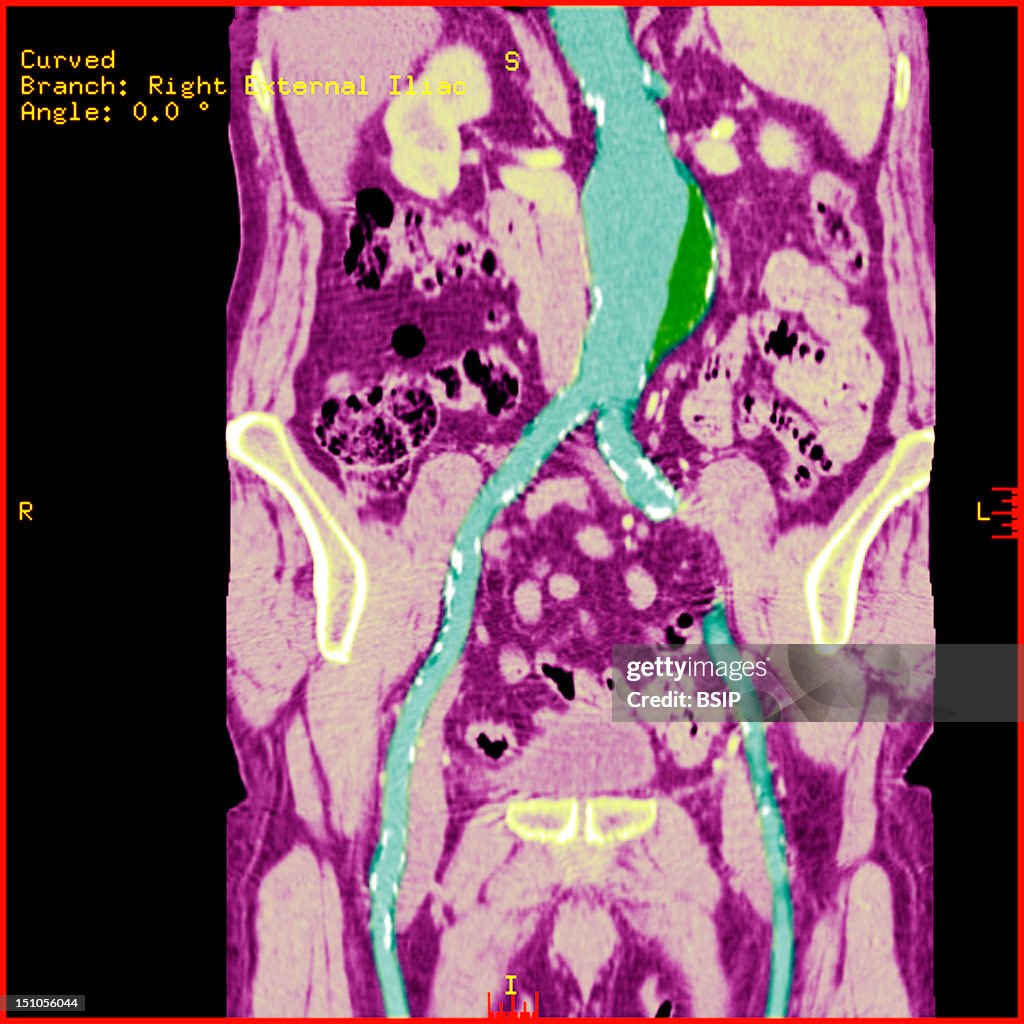 Abdominal Aorta Aneurysm, Scan