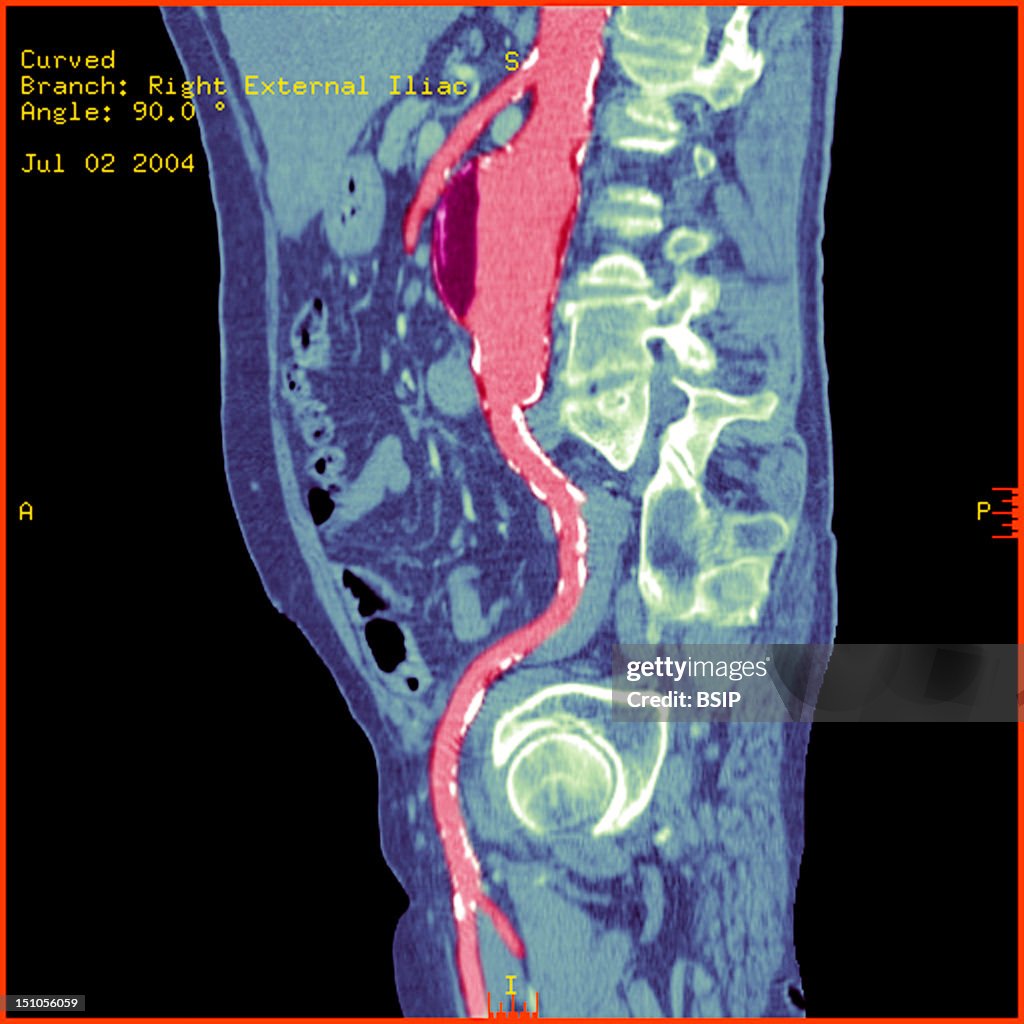 Abdominal Aorta Aneurysm, Scan