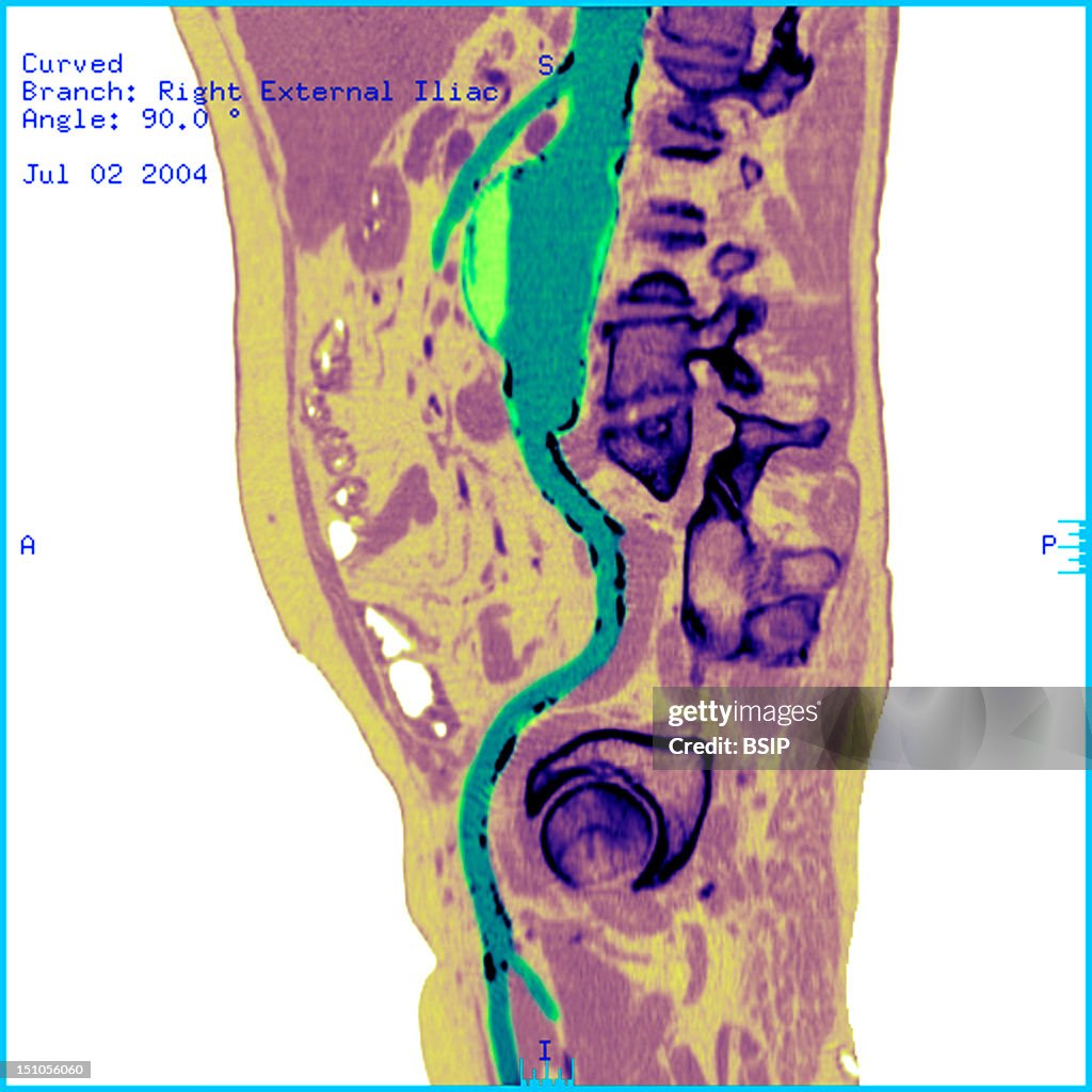 Abdominal Aorta Aneurysm, Scan