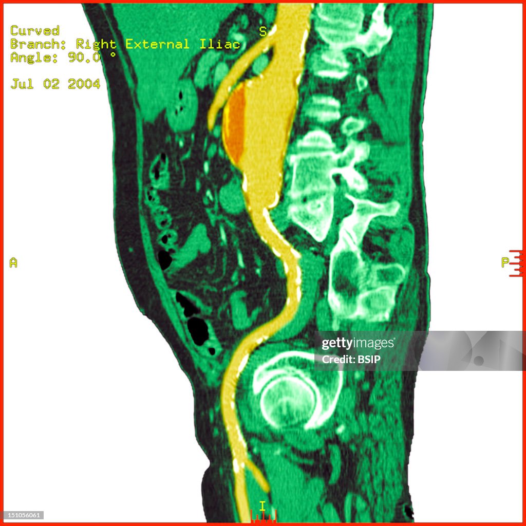 Abdominal Aorta Aneurysm, Scan