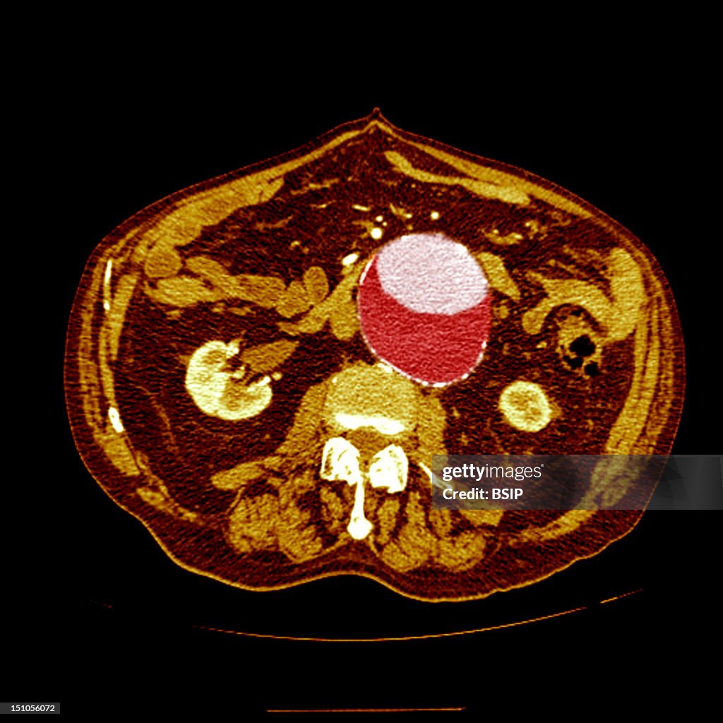 Abdominal Aorta Aneurysm, Scan