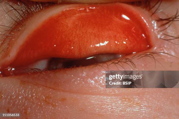 Acute Follicular Conjunctivitis Due To Chlamydia Infection.