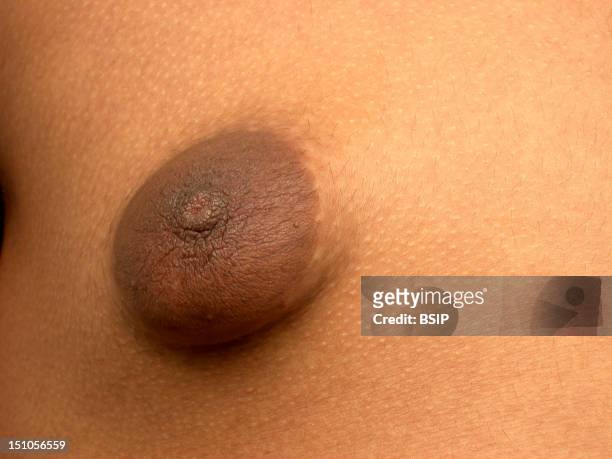 Gynecomastia On Tubular Breasts In A 18 Year Old Young Man.