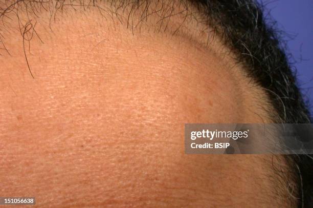 Frontal Lipoma.