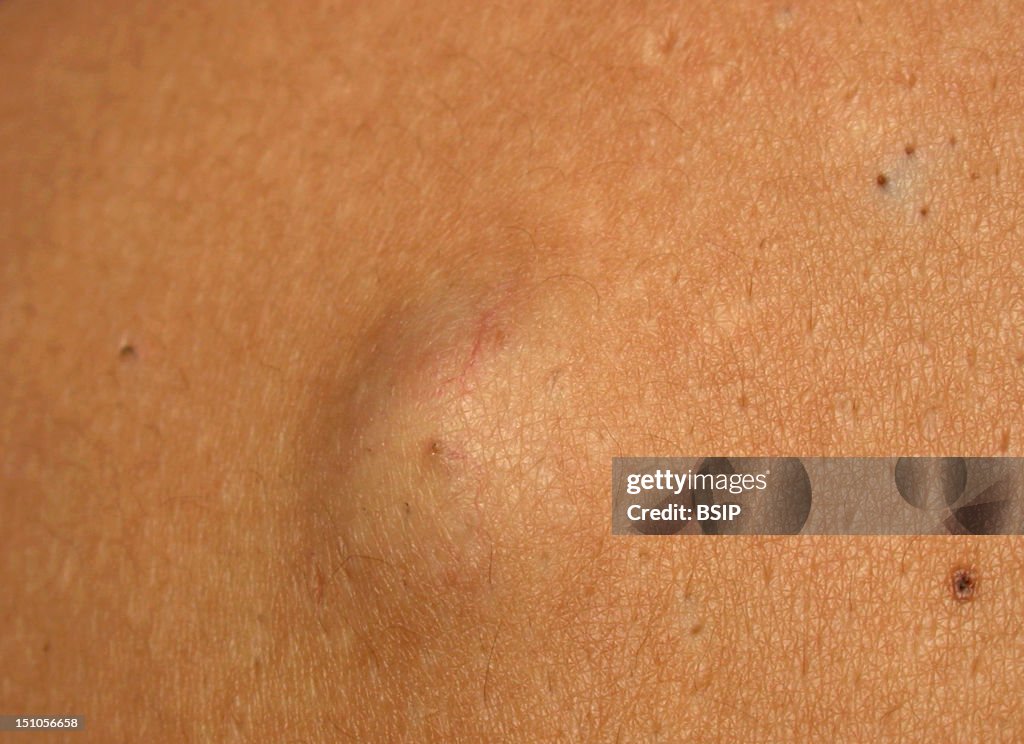 Sebaceous Cyst