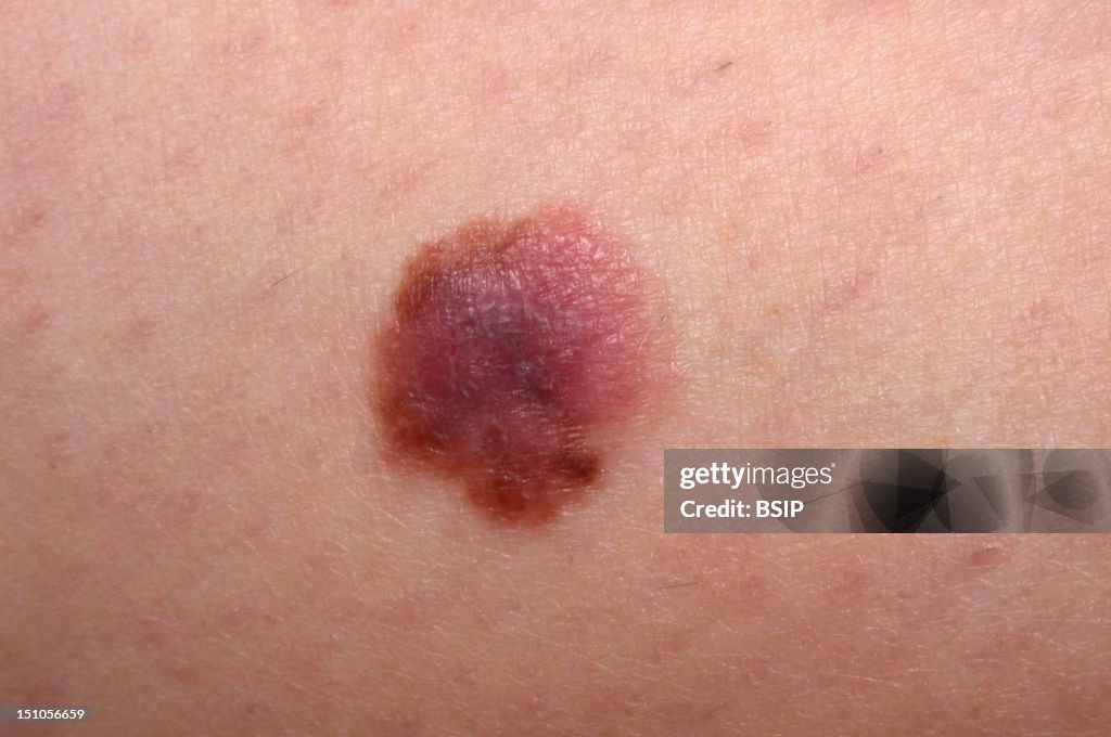 Melanoma Of The Calf Of The Left Leg News Photo Getty Images melanoma-of-the-calf-of-the-left-leg-news-photo-getty-images