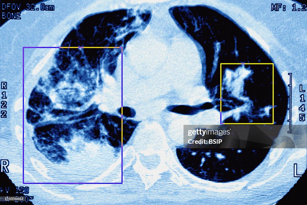 Pneumonia, Pneumocystis Carinii