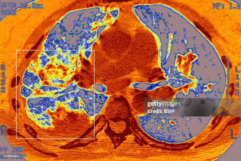 Pneumonia, Pneumocystis Carinii
