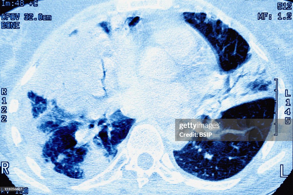 Pneumonia, Pneumocystis Carinii