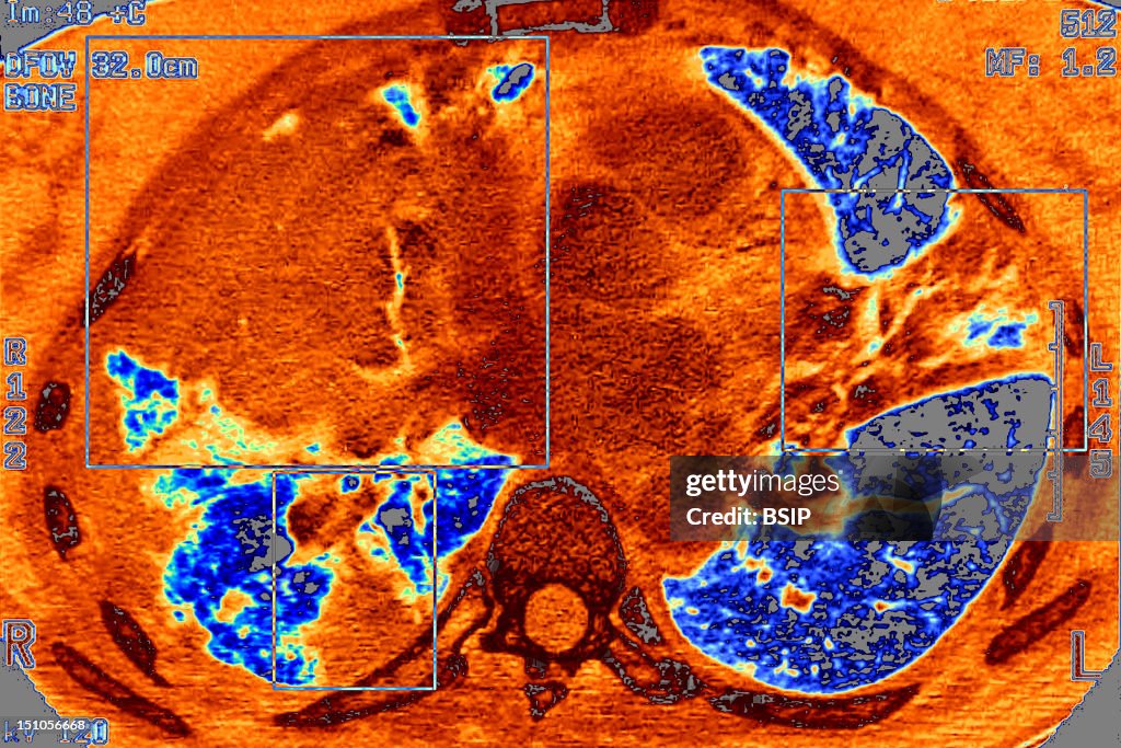 Pneumonia, Pneumocystis Carinii