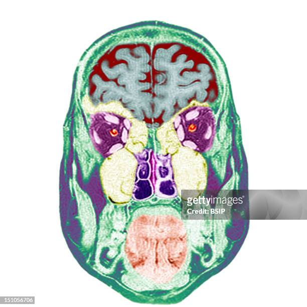 Frontal Section. Cf. Image 0211206 For The Numbers. 1. Brain. 2. Eyeballs. 3. Optic Nerves. 4. Oculo Motor Muscles Superior Right; Inferior Right;...