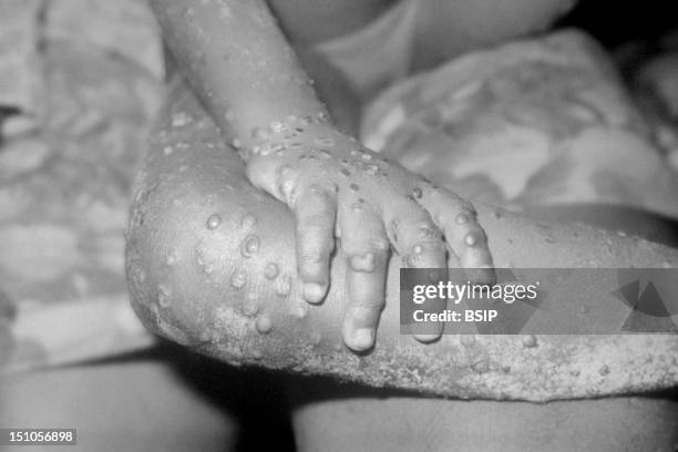 Monkeypox, A Member Of The Orthopox Family Of Viruses, Is An Infection Accidentally Transmitted To Humans Due To Its Similarity To The Smallpox...