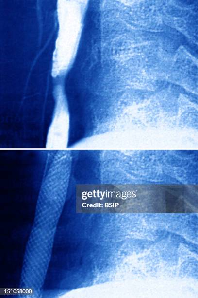 Carotid Stenosis Causing Cerebral Vascular Disorders. 2 Angioplasty 2 Stents Are Implanted In Order To Keep The Artery Open. Sagittal Neck Angiogram...