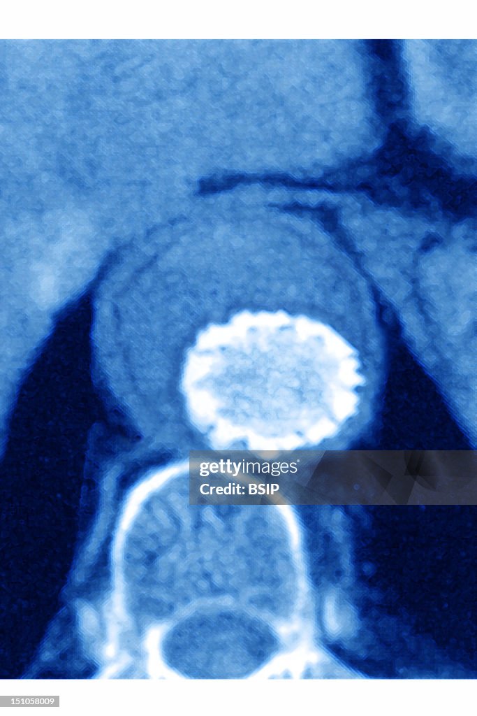 Arterial Angioplasty, Result