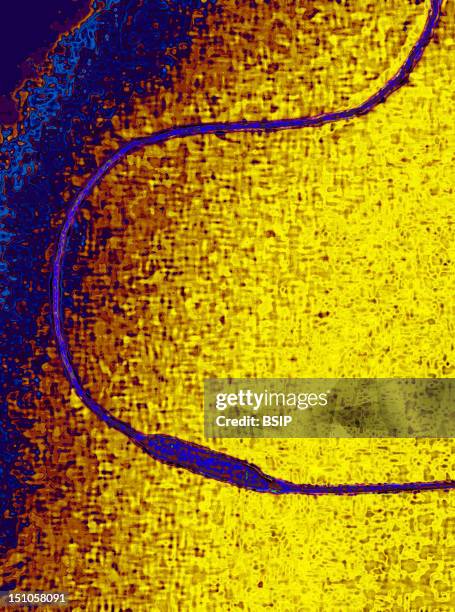 Angioplasty Of The Coronary Artery Following A Myocardial Infarction. Angioplastry By Balloon Catheter. The Balloon Is Inflated Progressively In The...