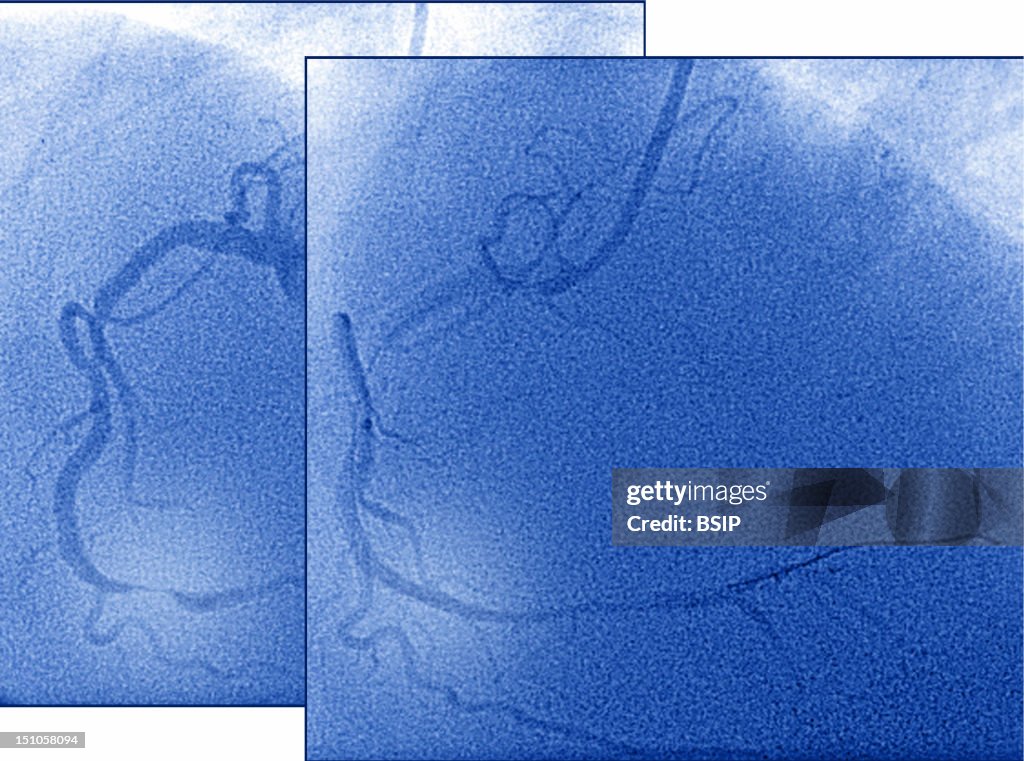 Arterial Angioplasty, Result