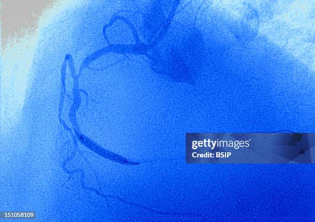 Angioplasty Of The Coronary Artery Following A Myocardial Infarction. Angioplastry By Balloon Catheter. The Balloon Is Inflated Progressively In The...