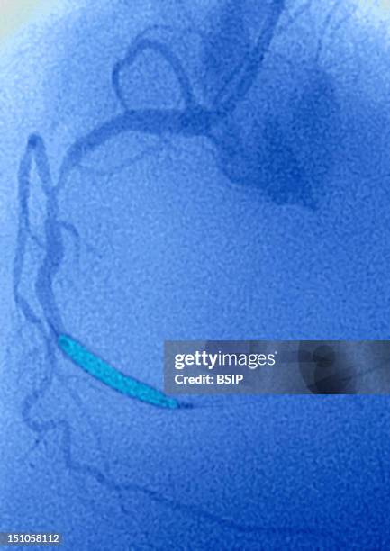 Angioplasty Of The Coronary Artery Following A Myocardial Infarction. Angioplastry By Balloon Catheter. The Balloon Is Inflated Progressively In The...