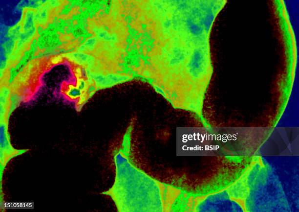 Iliac Colon Carcinoma. Abdominal X Ray In Front View.